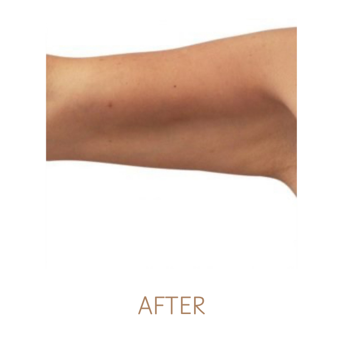 BEFORE SKIN TIGHTENING