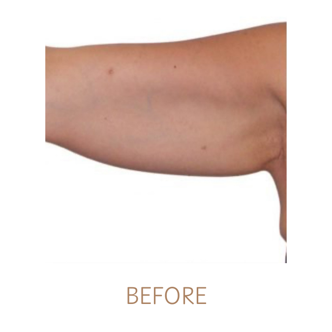 BEFORE SKIN TIGHTENING